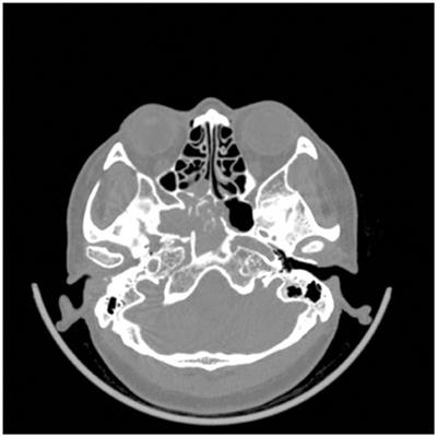 Headache Secondary to Isolated Sphenoid Sinus Fungus Ball: Retrospective Analysis of 6 Cases First Diagnosed in the Neurology Department